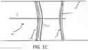 Fig. 03 - EMBOLISATION SYSTEM FOR PROMOTING CLOT FORMATION