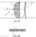 Fig. 04 - EMBOLISATION SYSTEM FOR PROMOTING CLOT FORMATION