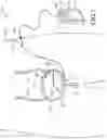 Fig. 02 - ARTIFICIAL BLADDER SYSTEM