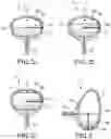Fig. 03 - ARTIFICIAL BLADDER SYSTEM