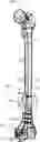 Fig. 01 - BONE FIXATION DEVICES, SYSTEMS, AND METHODS