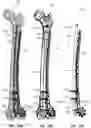 Fig. 28 - BONE FIXATION DEVICES, SYSTEMS, AND METHODS