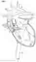 Fig. 02 - INTRAVASCULAR BLOOD PUMP