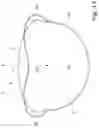 Fig. 07 - CARDIOVASCULAR DEVICE AND KIT FOR THE REDUCTION OF A CARDIAC CAVITY