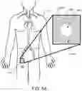 Fig. 11 - COMPOSITE POSITIVE AND NEGATIVE POISSON'S RATIO MATERIALS FOR MEDICAL DEVICES