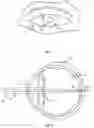Fig. 02 - OPHTHALMIC PINHOLE PROSTHETIC WITH SURFACE MODIFICATIONS AND METHOD OF FABRICATION