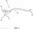 Fig. 02 - System and Method for Urinary Blockage Removal