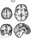 Fig. 09 - DETERMINING SUBTYPES OF SCHIZOPHRENIA IN A SUBJECT, TREATMENT OF SCHIZOPHRENIA, MEDICAMENT FOR TREATING SCHIZOPHRENIA AND DETERMINING THE EFFICACY OF SUCH MEDICATION