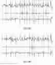 Fig. 11 - APPARATUS AND METHOD FOR ELECTROCARDIOGRAM (