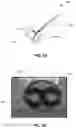 Fig. 07 - CIRCUMFERENTIAL ABLATION DEVICES AND METHODS