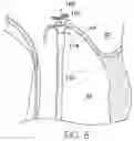 Fig. 05 - CONTROLLED SUTURE TENSIONING