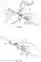 Fig. 08 - ANESTHESIA SAFETY NEEDLE DEVICE