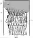 Fig. 08 - Inverting thrombectomy apparatuses and methods