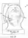 Fig. 16 - DEVICES AND METHODS FOR NEGATIVE PRESSURE THERAPY