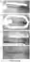 Fig. 32 - DEVICES AND METHODS FOR NEGATIVE PRESSURE THERAPY