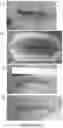 Fig. 33 - DEVICES AND METHODS FOR NEGATIVE PRESSURE THERAPY