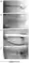 Fig. 34 - DEVICES AND METHODS FOR NEGATIVE PRESSURE THERAPY