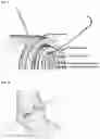 Fig. 02 - TREATMENT OF ANASTOMOSES
