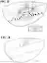 Fig. 16 - Detection and Treatment of Obstructive Sleep Apnea
