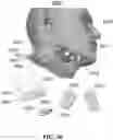 Fig. 23 - Detection and Treatment of Obstructive Sleep Apnea