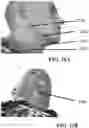 Fig. 24 - Detection and Treatment of Obstructive Sleep Apnea