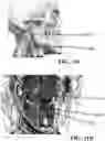 Fig. 25 - Detection and Treatment of Obstructive Sleep Apnea