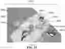 Fig. 27 - Detection and Treatment of Obstructive Sleep Apnea