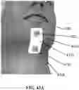 Fig. 35 - Detection and Treatment of Obstructive Sleep Apnea