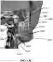Fig. 37 - Detection and Treatment of Obstructive Sleep Apnea