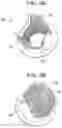 Fig. 06 - STENT-VALVES FOR VALVE REPLACEMENT AND ASSOCIATED METHODS AND SYSTEMS FOR SURGERY