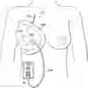 Fig. 01 - Negative-pressure wound therapy dressing with zone of ambient pressure
