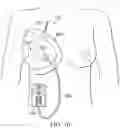 Fig. 09 - Negative-pressure wound therapy dressing with zone of ambient pressure