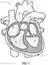 Fig. 02 - Mitral heart valve replacement