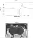 Fig. 04 - Bulk Acoustic Resonator and Filter