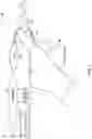 Fig. 02 - MEDICAL DEVICE WITH REMOVABLE MOTOR