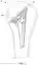 Fig. 02 - OFFSET ADAPTERS, TRIAL IMPLANT SYSTEMS, AND IMPLANT SYSTEMS ALLOWING FOR SELECTABLE ECCENTRICITY