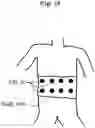 Fig. 22 - SURFACE AND SUBSURFACE ELECTRODES FOR GUIDING STIMULATION ELECTRIC CURRENTS WITH ELECTRIC FIELDS FOR COCHLEA IMPLANTED ELECTRODES
