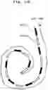 Fig. 33 - SURFACE AND SUBSURFACE ELECTRODES FOR GUIDING STIMULATION ELECTRIC CURRENTS WITH ELECTRIC FIELDS FOR COCHLEA IMPLANTED ELECTRODES