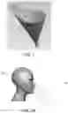 Fig. 02 - EXTRAORAL VACUUM AEROSOL CUP AND METHOD OF USE