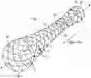 Fig. 01 - CEREBRAL DURAL VENOUS SINUS STENT