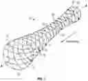 Fig. 02 - CEREBRAL DURAL VENOUS SINUS STENT