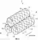 Fig. 06 - CEREBRAL DURAL VENOUS SINUS STENT