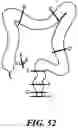 Fig. 48 - Cooperative access hybrid procedures