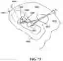 Fig. 66 - Cooperative access hybrid procedures
