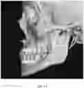 Fig. 02 - REDUCTION SPLINT FOR EDENTULOUS PATIENTS