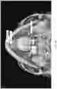 Fig. 03 - REDUCTION SPLINT FOR EDENTULOUS PATIENTS
