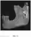 Fig. 09 - REDUCTION SPLINT FOR EDENTULOUS PATIENTS