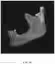 Fig. 13 - REDUCTION SPLINT FOR EDENTULOUS PATIENTS