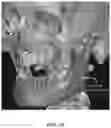 Fig. 15 - REDUCTION SPLINT FOR EDENTULOUS PATIENTS