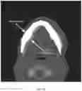 Fig. 16 - REDUCTION SPLINT FOR EDENTULOUS PATIENTS